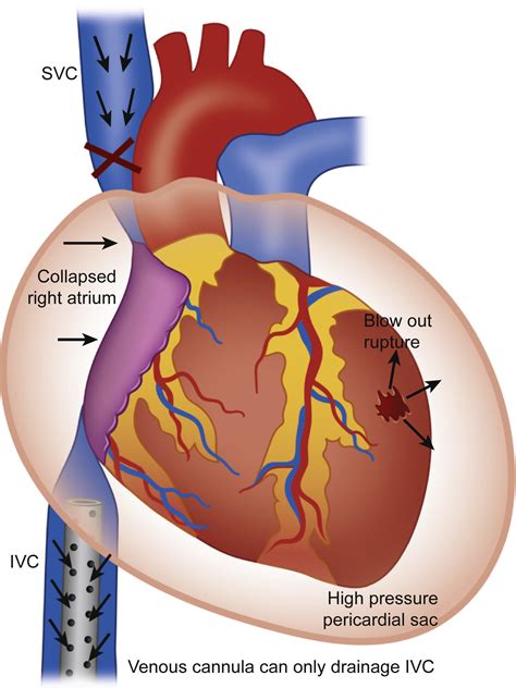 lv rupture|free ventricular wall rupture.